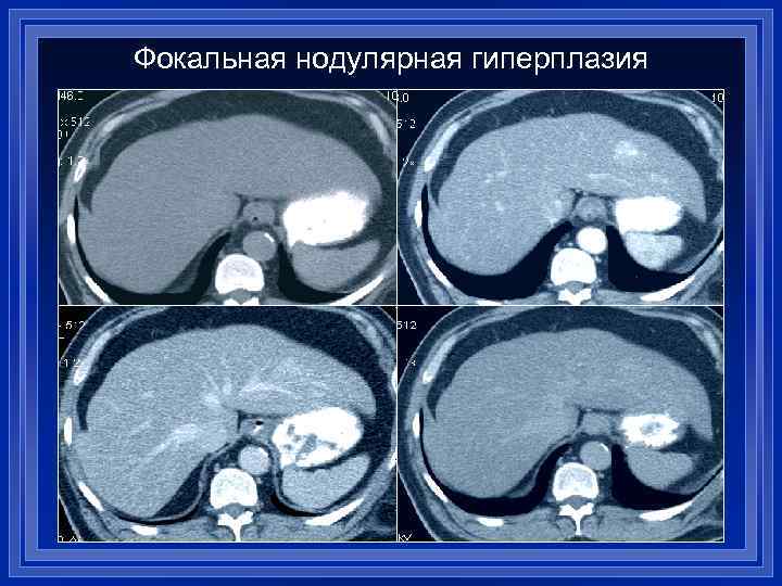 Фокальная нодулярная гиперплазия 