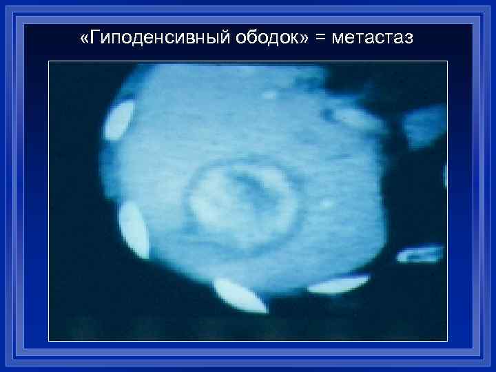  «Гиподенсивный ободок» = метастаз 