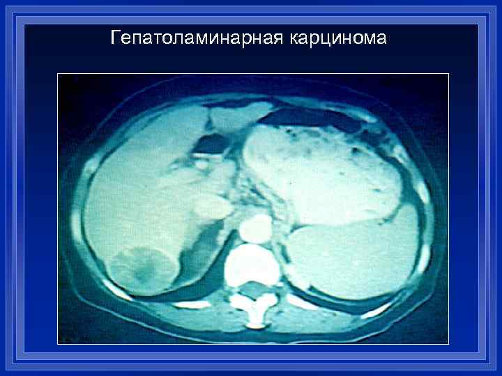 Гепатоламинарная карцинома 
