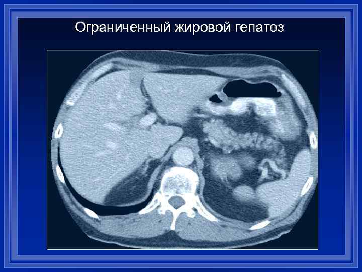 Какие признаки стеатоза печени выявляются при компьютерной томографии