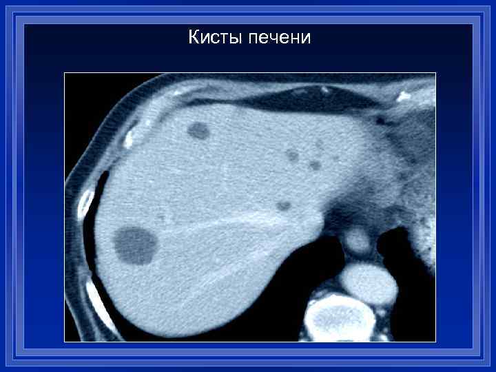 Кисты печени 