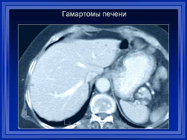 Гамартомы печени 