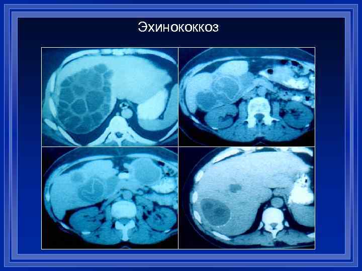 Эхинококкоз 