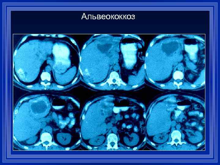 Альвеококкоз 