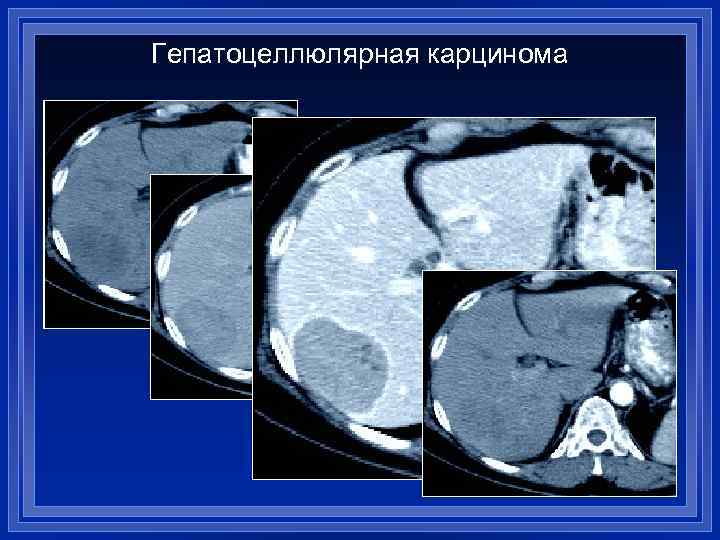 Гепатоцеллюлярная карцинома 