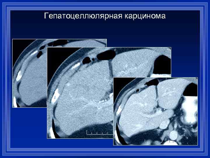 Гепатоцеллюлярная карцинома 