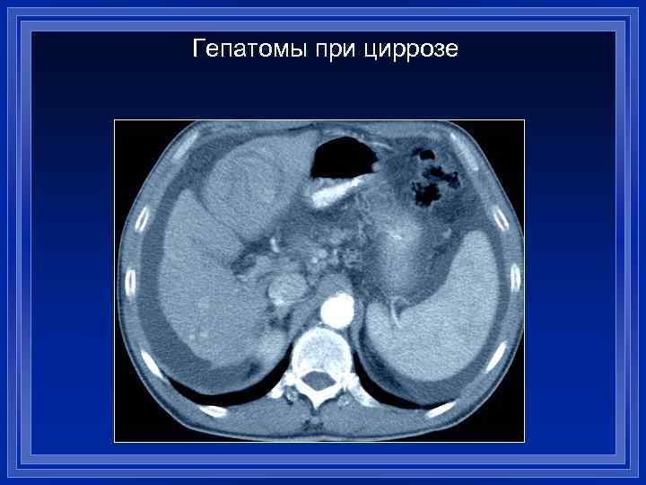 Гепатомы при циррозе 