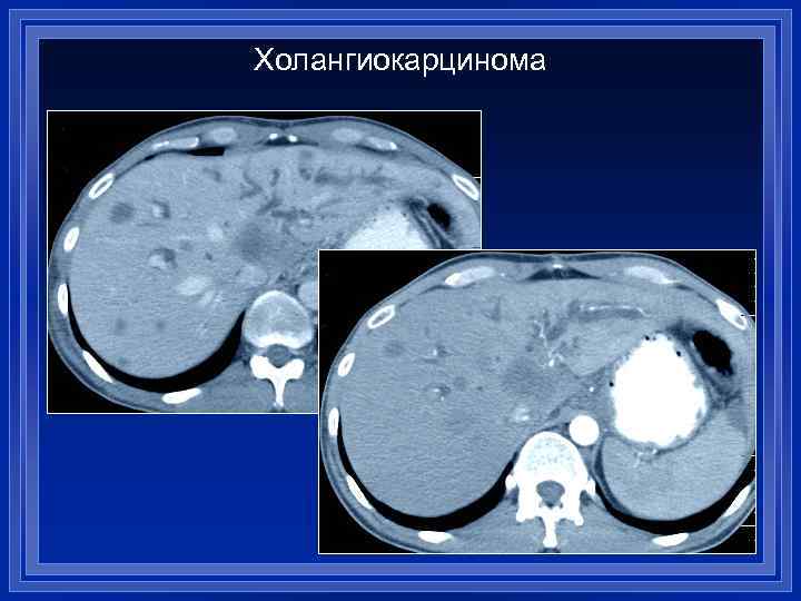 Холангиокарцинома 