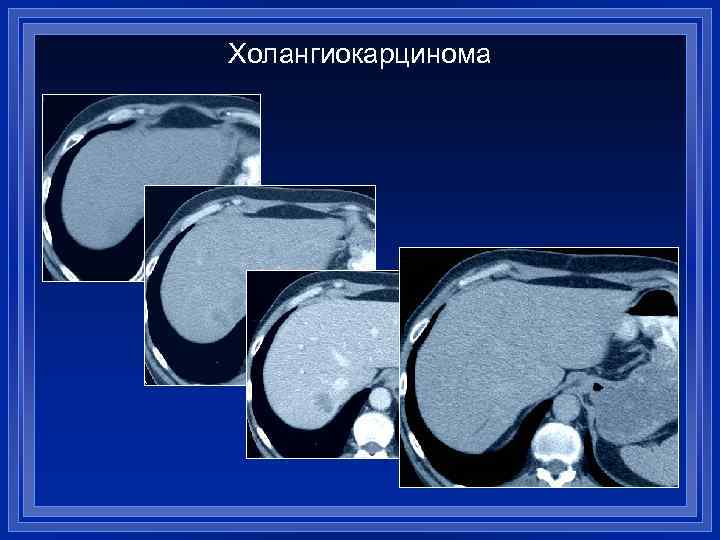 Холангиокарцинома 