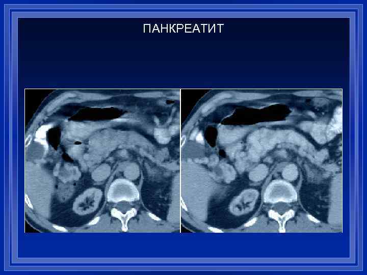 ПАНКРЕАТИТ 