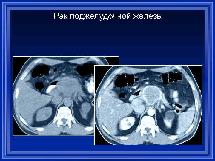 Какие признаки стеатоза печени выявляются при компьютерной томографии