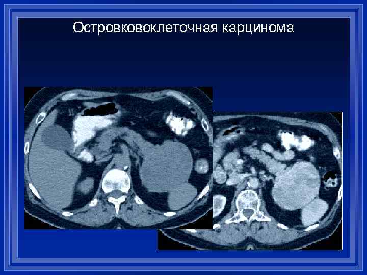 Островковоклеточная карцинома 