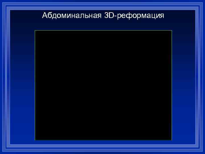 Абдоминальная 3 D-реформация 