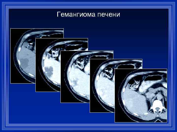 Гемангиома печени 