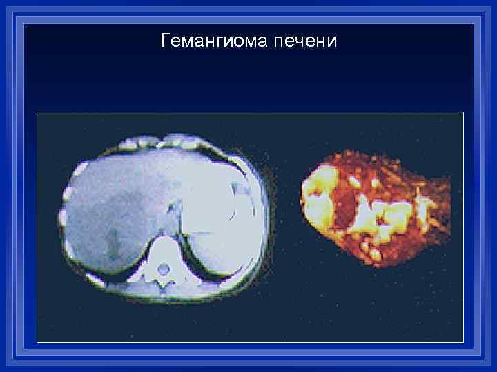 Гемангиома печени 