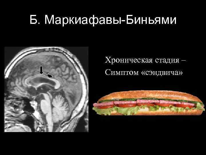 Б. Маркиафавы-Биньями Хроническая стадия – Симптом «сэндвича» 