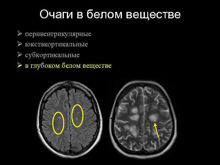 Немногочисленных супратенториальных очагов глиоза сосудистого генеза мр картина