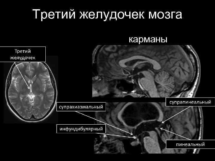 Третий желудочек мозга карманы 