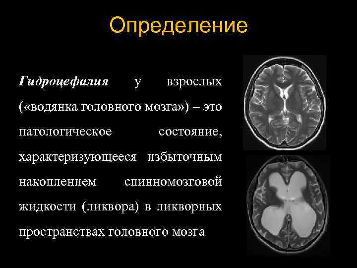 Определение Гидроцефалия у взрослых ( «водянка головного мозга» ) – это патологическое состояние, характеризующееся