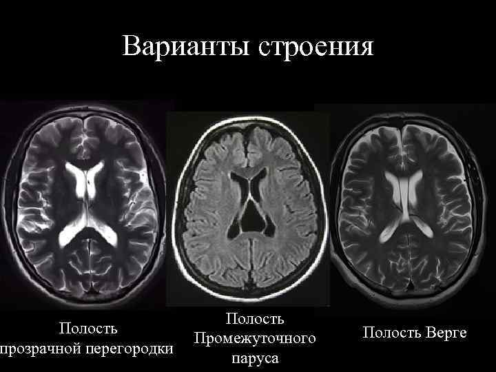 Варианты строения Полость Промежуточного прозрачной перегородки паруса Полость Верге 