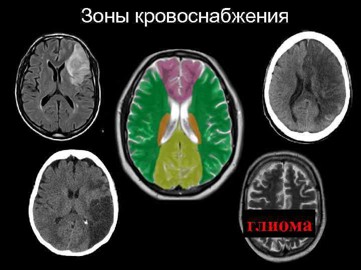 Зоны кровоснабжения глиома 