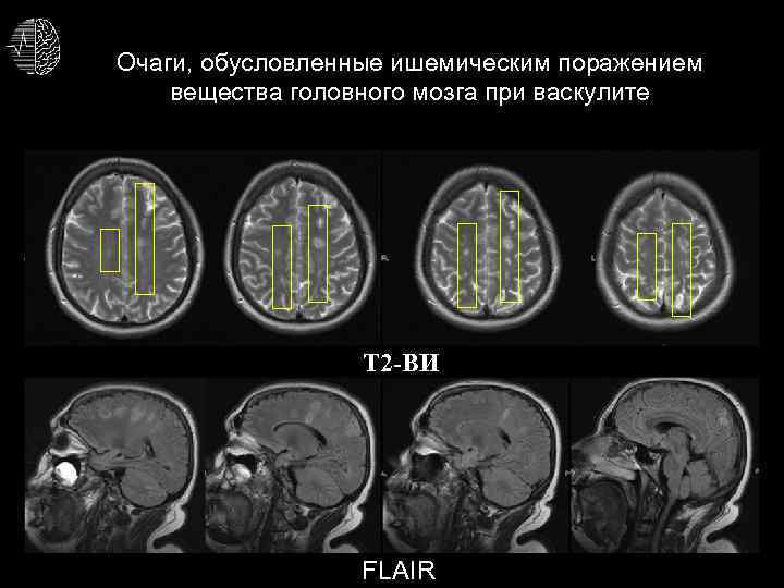 Очаги, обусловленные ишемическим поражением вещества головного мозга при васкулите Т 2 -ВИ FLAIR 
