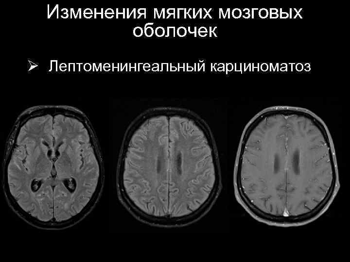 Изменения мягких мозговых оболочек Ø Лептоменингеальный карциноматоз 