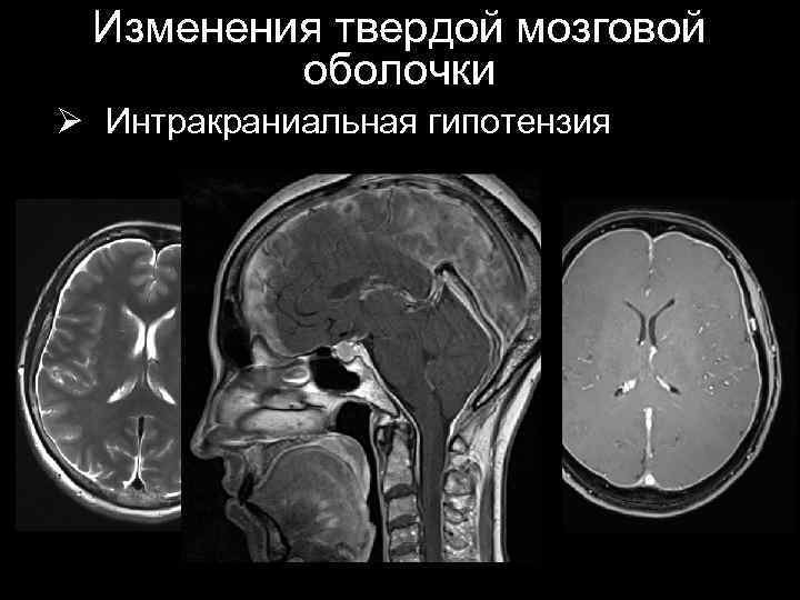 Изменения твердой мозговой оболочки Ø Интракраниальная гипотензия 