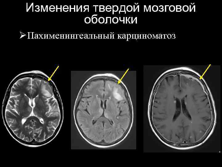 Изменения твердой мозговой оболочки Ø Пахименингеальный карциноматоз 