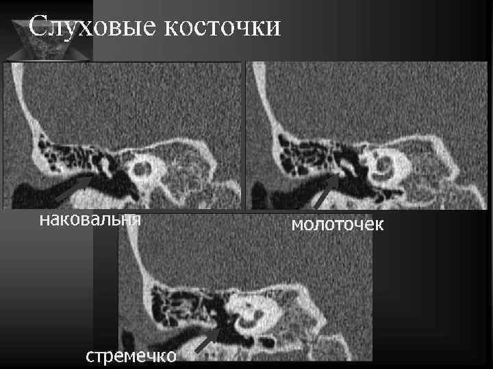 Кт височных костей фото