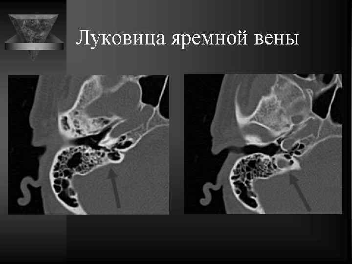 Кт височной кости в норме. Отосклероз на кт височных костей. Луковица яремной вены на кт височных костей. Кт височных костей жидкость.