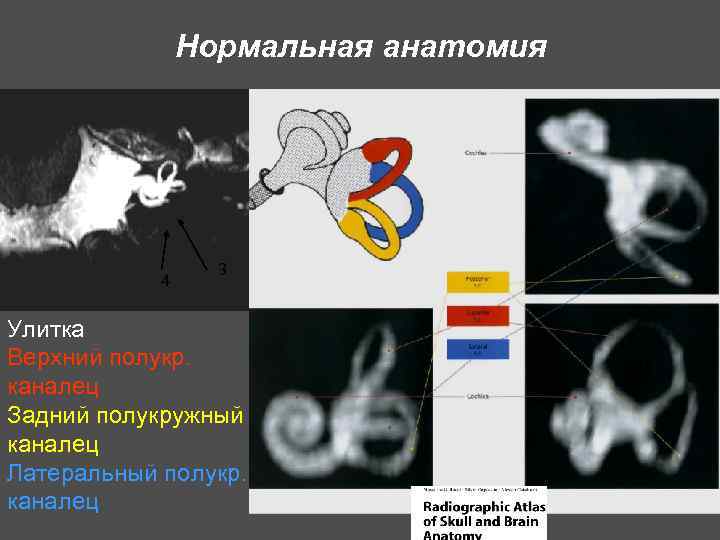 Нормальная анатомия 4 3 Улитка Верхний полукр. каналец Задний полукружный каналец Латеральный полукр. каналец