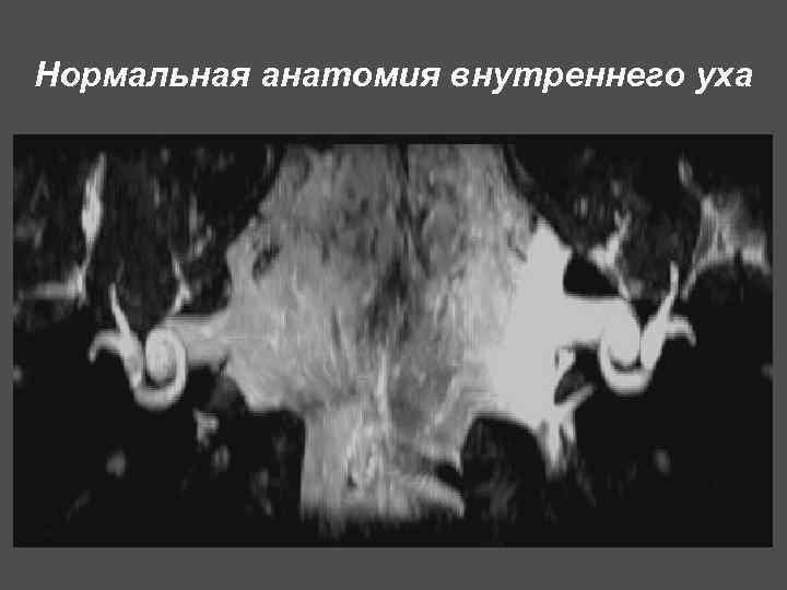 Нормальная анатомия внутреннего уха 