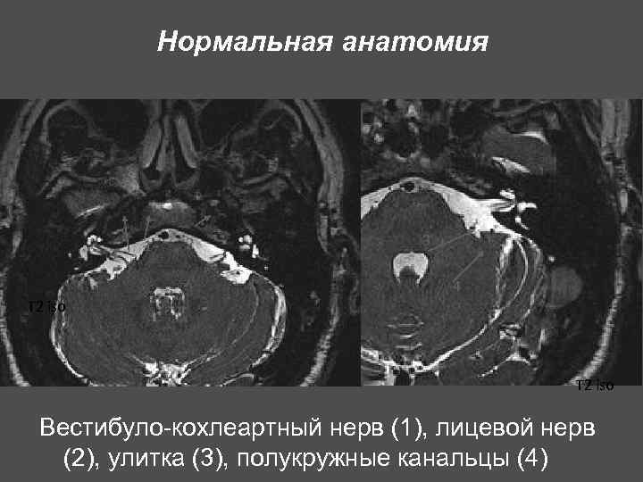 Нормальная анатомия 4 1 2 3 4 T 2 iso Вестибуло-кохлеартный нерв (1), лицевой