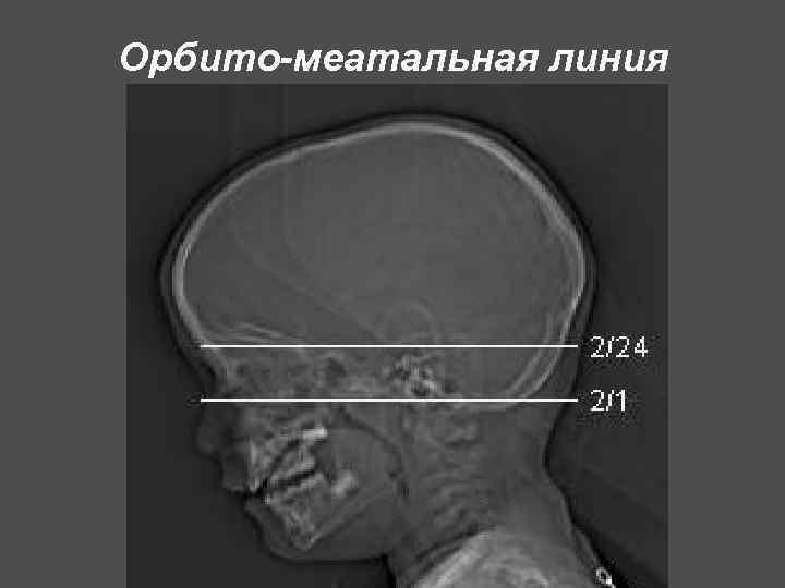 Орбито-меатальная линия 