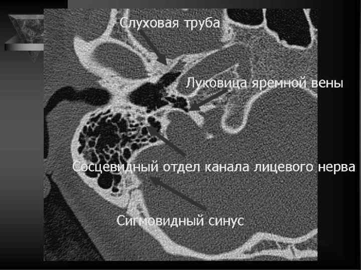 Кт височных костей фото