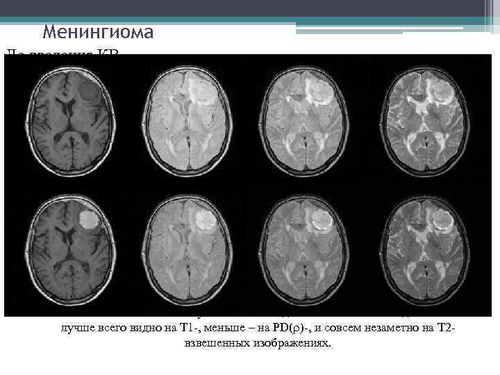 Менингиома До введения КВ Т 1 PD Т 2 После введения КВ Усиление сигнала