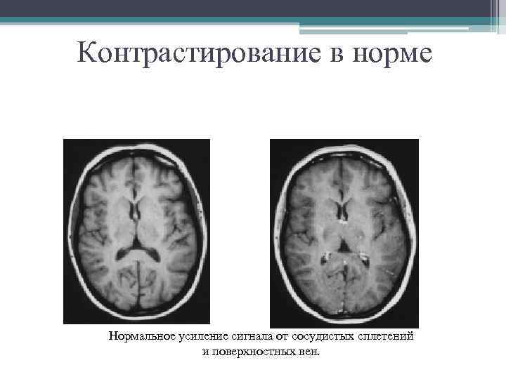 Контрастирование в норме Нормальное усиление сигнала от сосудистых сплетений и поверхностных вен. 