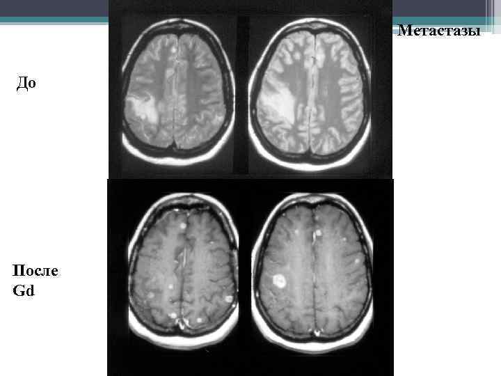 Метастазы До После Gd 