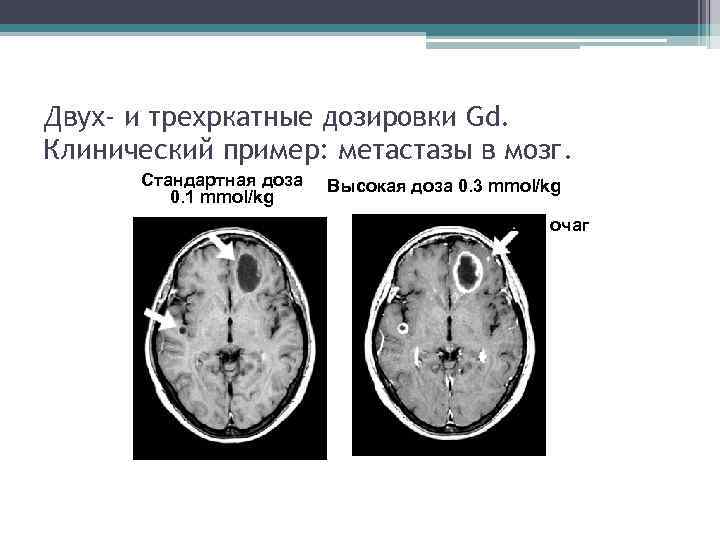 Двух- и трехркатные дозировки Gd. Клинический пример: метастазы в мозг. Стандартная доза 0. 1