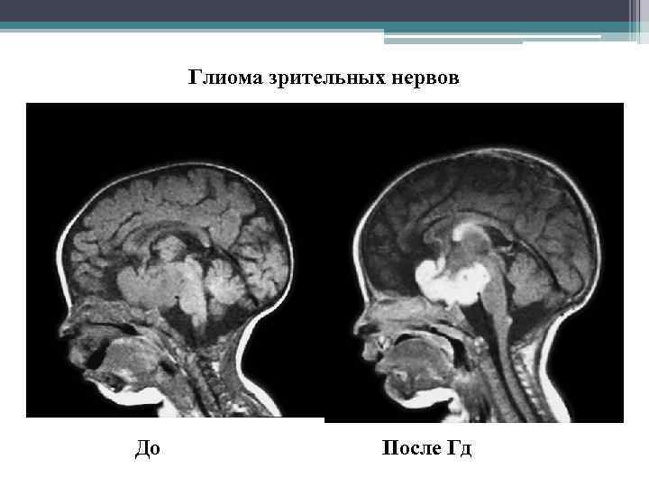 Глиома зрительных нервов До После Гд 