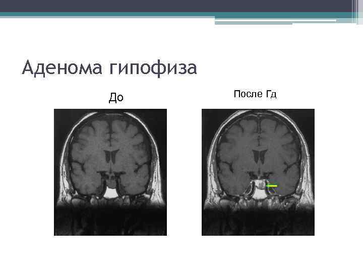 Аденома гипофиза До После Гд 