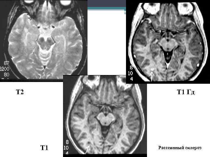 Т 2 Т 1 Гд Т 1 Рассеянный склероз 