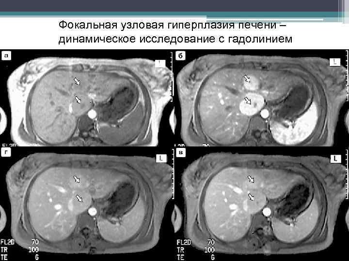 Фокальная узловая гиперплазия печени – динамическое исследование с гадолинием 