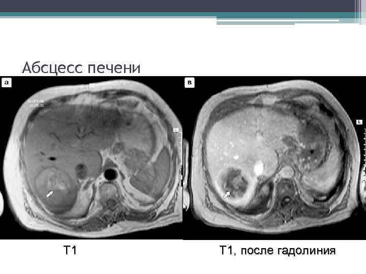 Абсцесс печени Т 1 Т 1, после гадолиния 