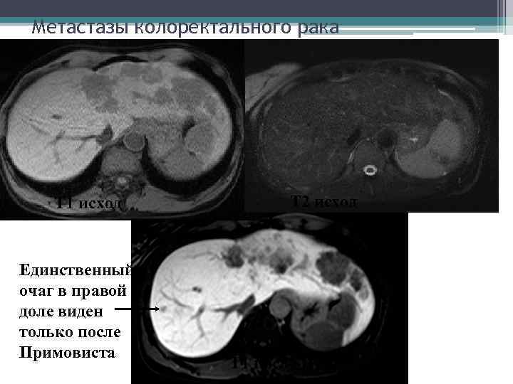 Метастазы колоректального рака Т 1 исход Единственный очаг в правой доле виден только после