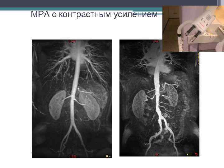 МРА с контрастным усилением 