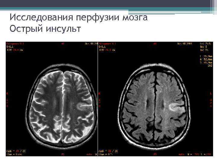 Исследования перфузии мозга Острый инсульт 