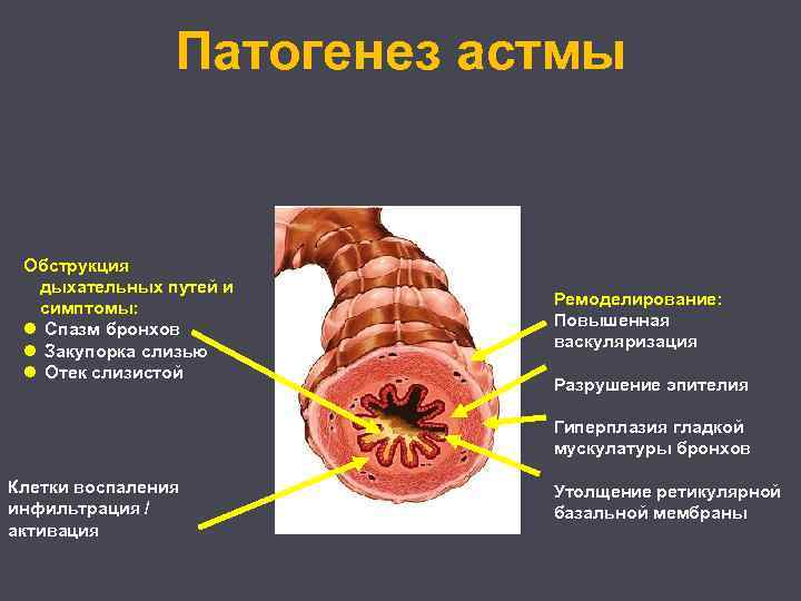 Патогенез астмы Обструкция дыхательных путей и симптомы: l Спазм бронхов l Закупорка слизью l