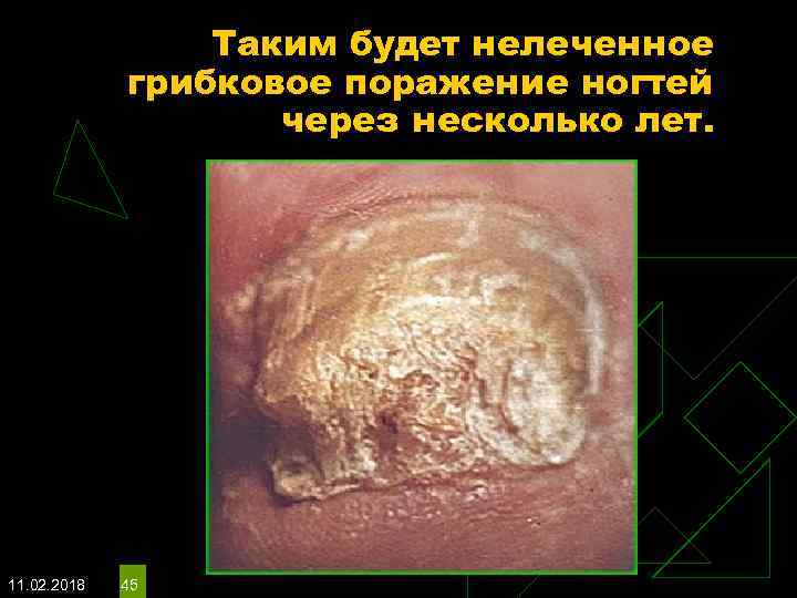 Таким будет нелеченное грибковое поражение ногтей через несколько лет. 11. 02. 2018 45 